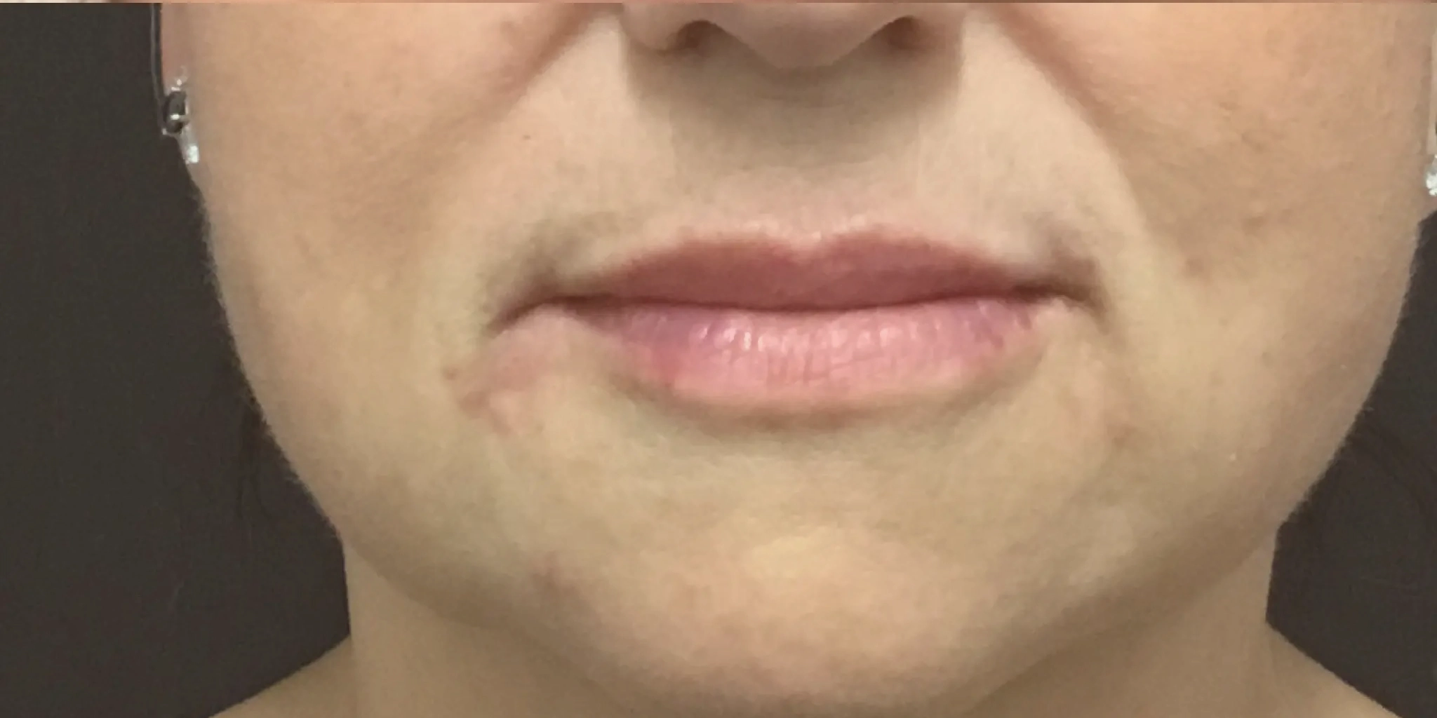 Close-up of lips plump and pretty after wrinkles treatment