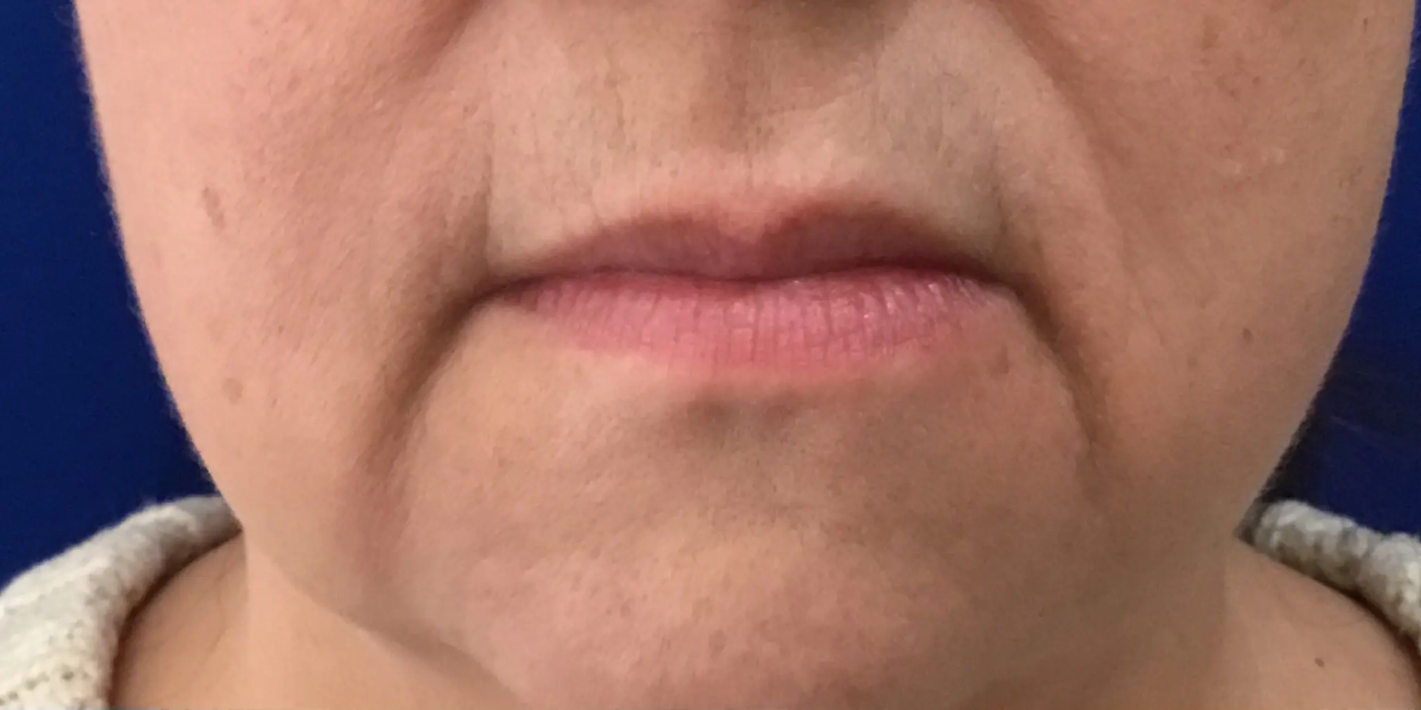 Close-up of lips before wrinkles treatment at Morpheus