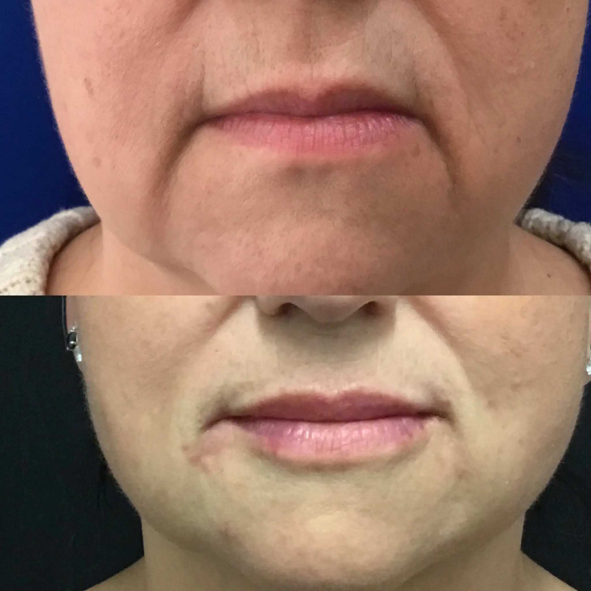 Before and after photo of patient for treatment of lines around mouth and lips
