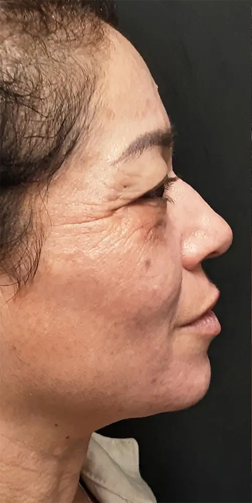 Profile photo of female patient's face showing before her MatrixPro treatment at our Santa Rosa medspa