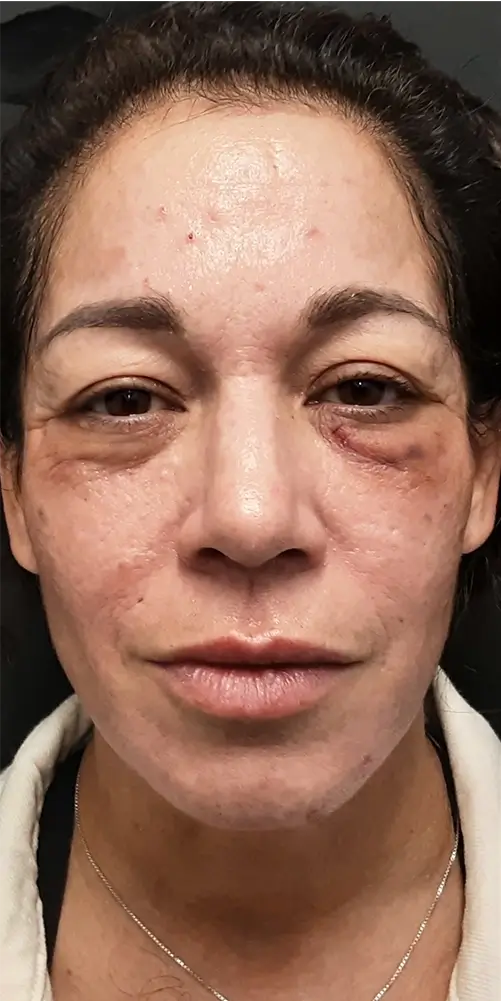 Before undergoing MatrixPro treatment, the woman's face exhibited noticeable puffiness around the eyes and wrinkles