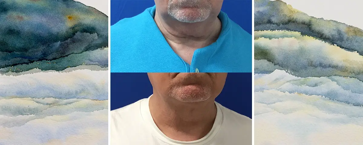 Medical Aesthetic Spa Treatments for Men with before and after photo of a patient with double chin
