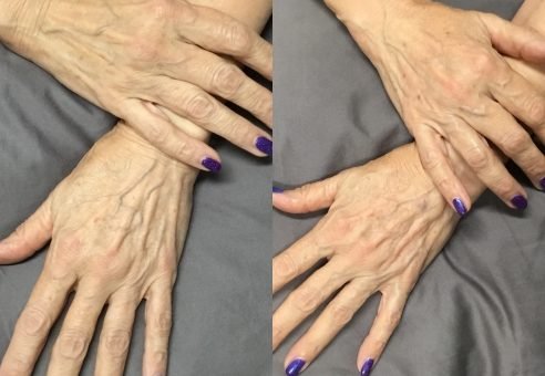 Hands before and after beauty treatment