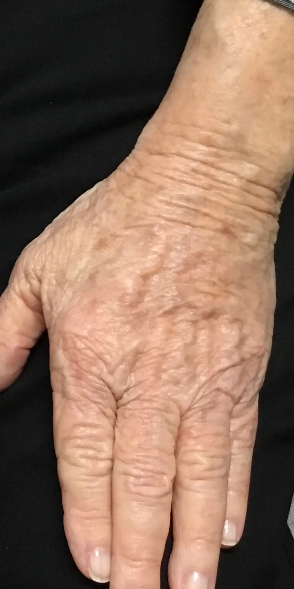 A close-up photograph showcasing decreased brown spots on a hand after receiving skin treatment at our med spa Sonoma County.