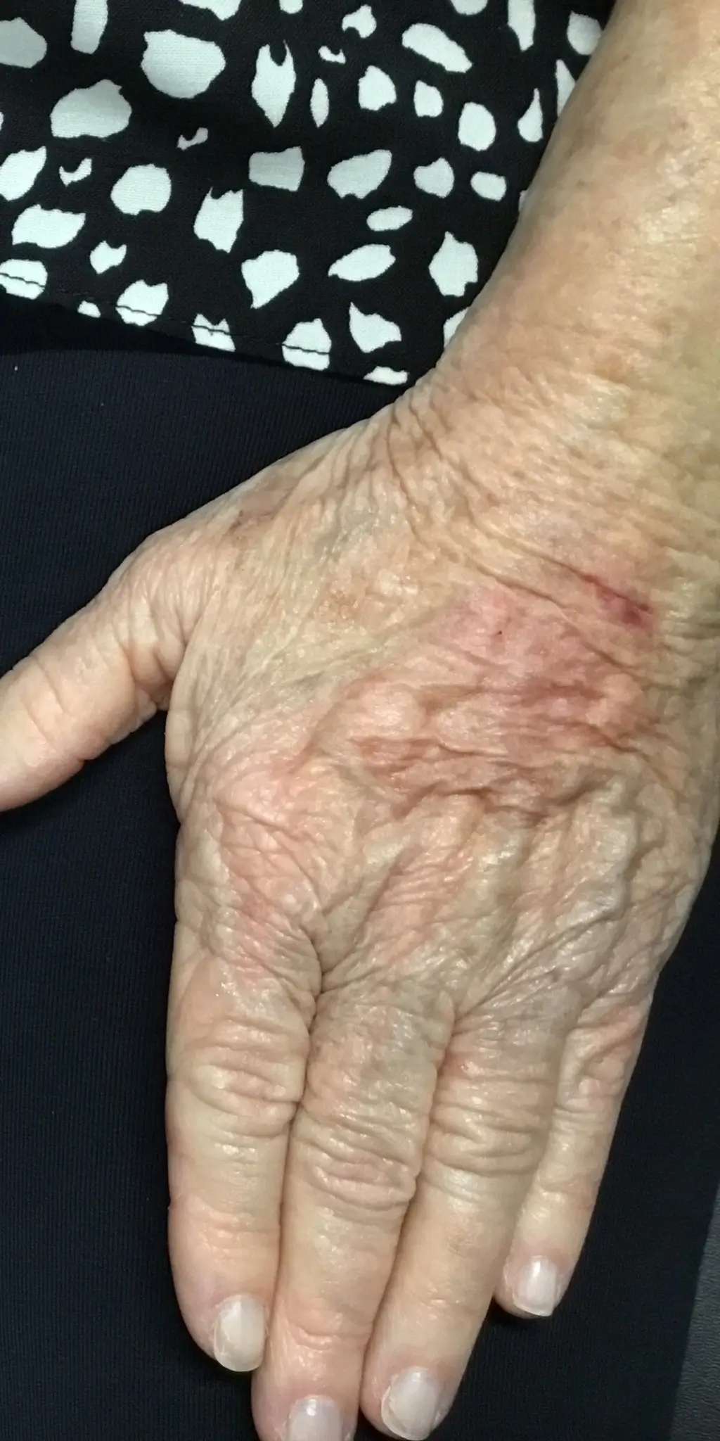 A close-up photograph showcasing aging brown spots on a hand before receiving skin treatment at Morpheus Medical Aesthetics, located in Santa Rosa.