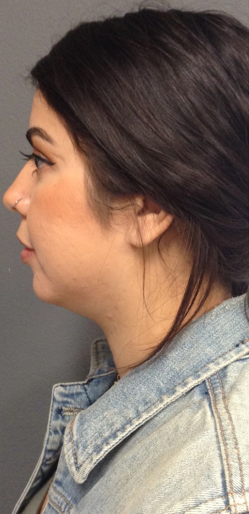 Chin before Kybella injections
