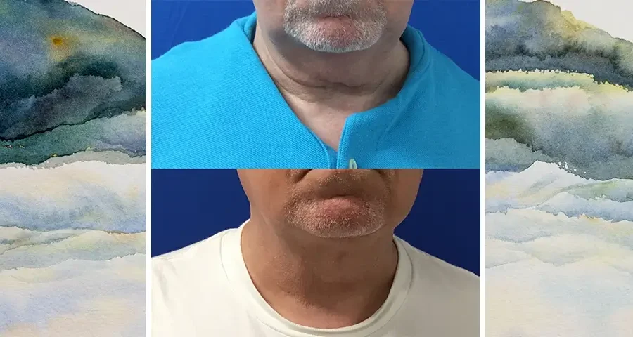 Medical Aesthetic Spa Treatments for Men with before and after photo of a patient with double chin