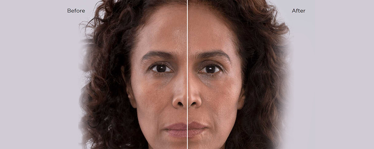 Sculptra Before and After Results | Med Spa Santa Rosa