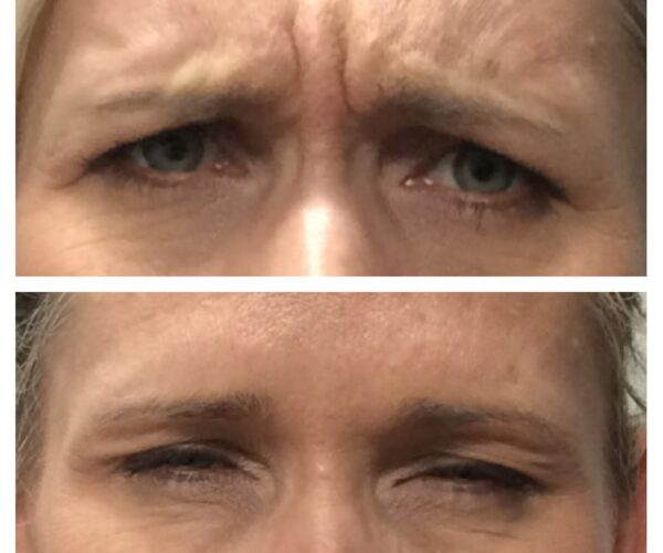 A woman's before and after results of Botox in Marin.