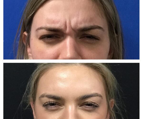 Before and after results of Botox in Santa Rosa.