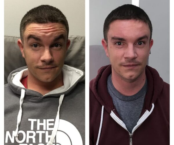 A man's before and after results of Botox in Marin.