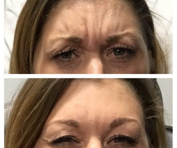 Before and after results of Botox in Marin.