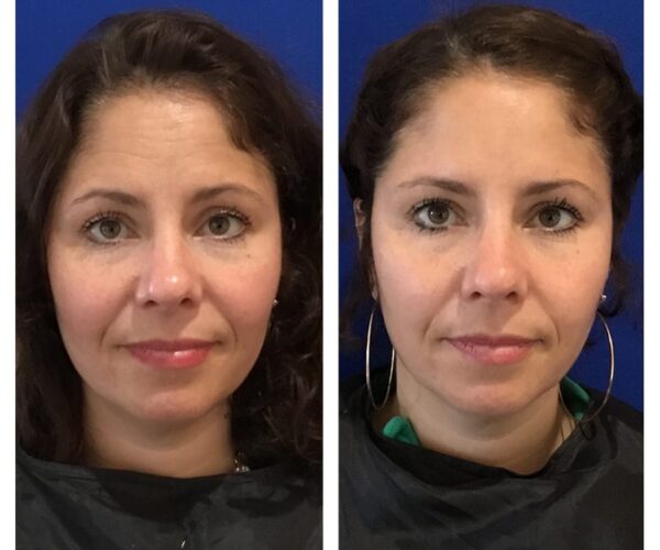 A woman's Botox results in Santa Rosa.